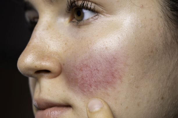 What is rosacea and how do you cure it?